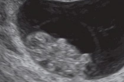 8 weeks pregnant scan