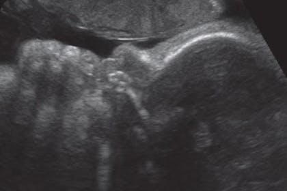 38 weeks pregnant scan