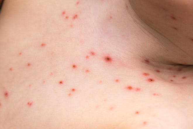 Skin rash could be a key symptom of coronavirus - Netmums