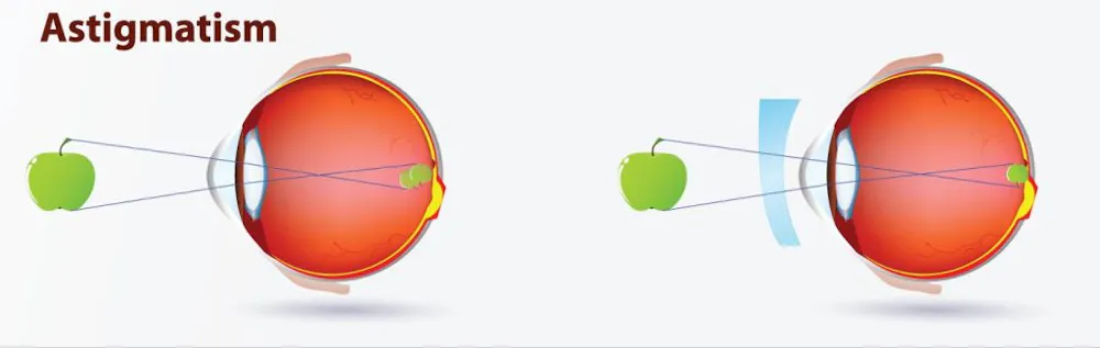Astig Frame Understanding Astigmatism: A Comprehensive Overview