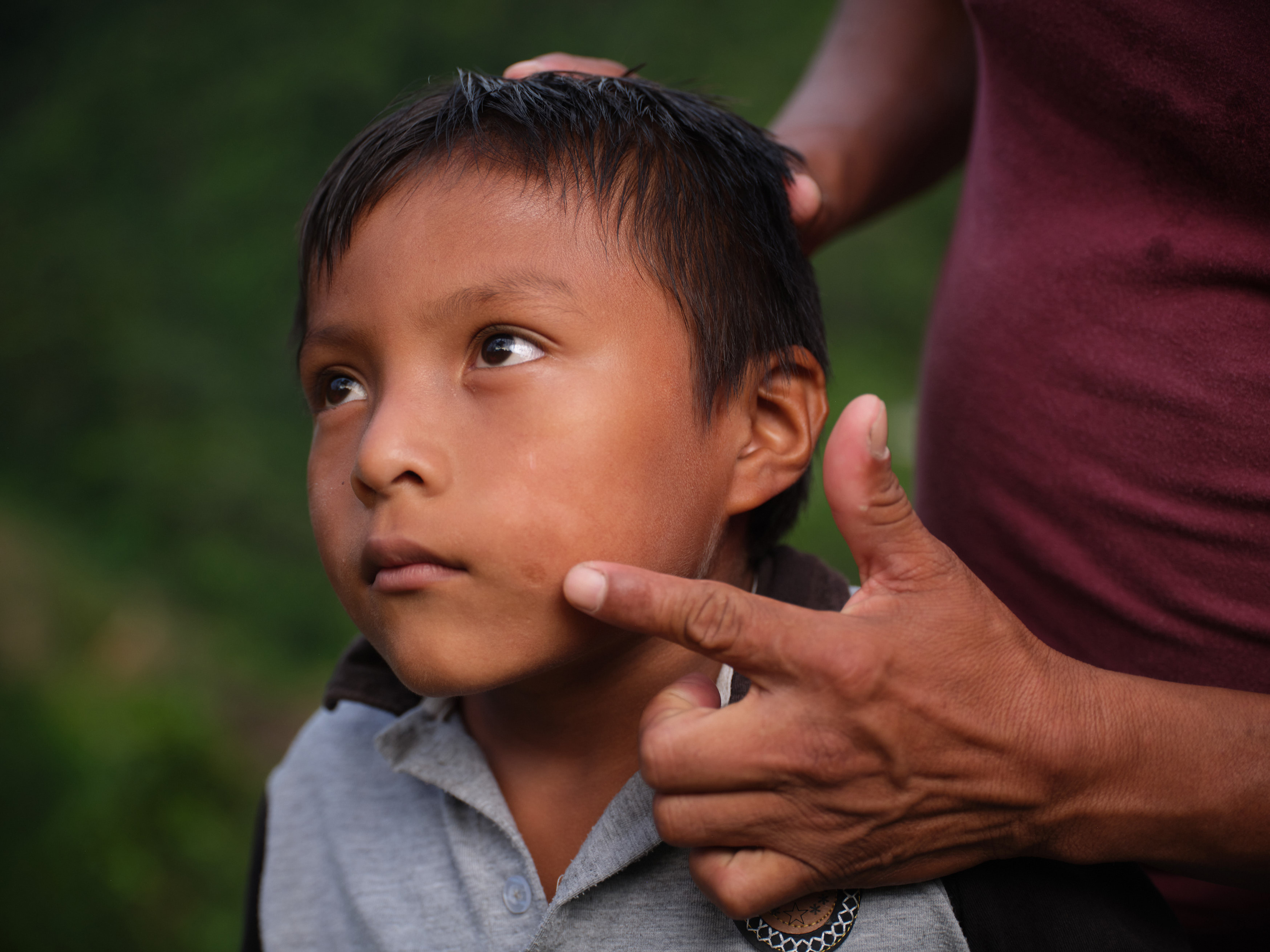 A columbian boy with a scar on his face.