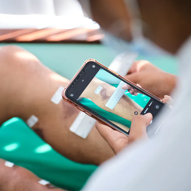 The most common method of treating CL typically requires 21 consecutive days of intramuscular injections at a hospital or clinic. Patients require close monitoring and follow-up appointments over six months. The difficult nature of these treatments and their economic impact means people often choose not to seek treatment or do not complete follow-up. Alexandra’s work focuses on developing new alternatives that can be easily and safely self-administered at home. Photo: A healthcare worker measures the size of a patient’s healed CL lesion.