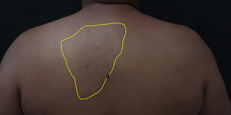 Patient with a leprosy lesion marked by an expert. This data is later fed into an AI algorithm. 