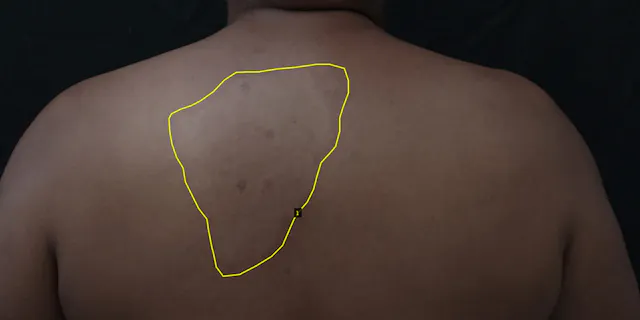 Patient with a leprosy lesion marked by an expert. This data is later fed into an AI algorithm.