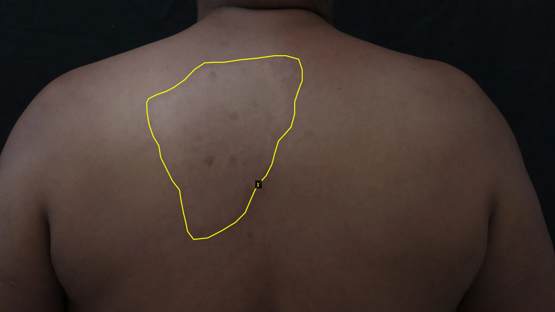 Patient with a leprosy lesion marked by an expert. This data is later fed into an AI algorithm. 