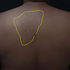 Patient with a leprosy lesion marked by an expert. This data is later fed into an AI algorithm. 