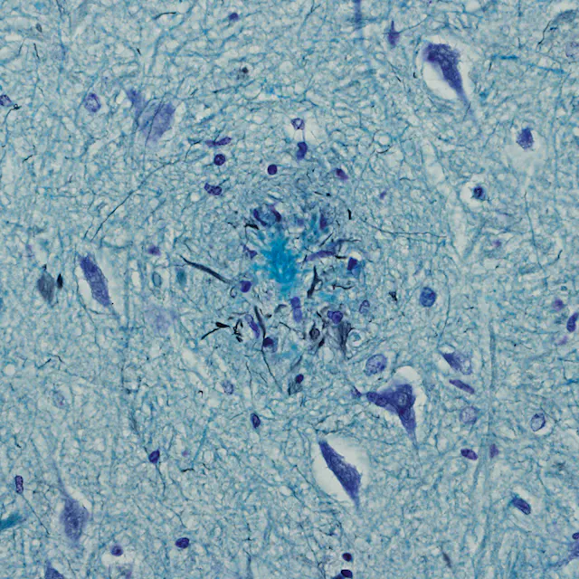 Protein deposits in the brain (so-called plaques) are symptomatic of dementia. The picture illustrates the senile plaques of an Alzheimer’s patient.