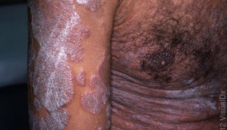 Image of an arm and torso of a man of color covered in psoriasis plaques.