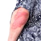 A woman's elbow is covered in a psoriasis lesion.