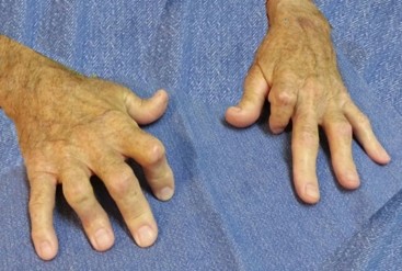 acute inflammation arthritis