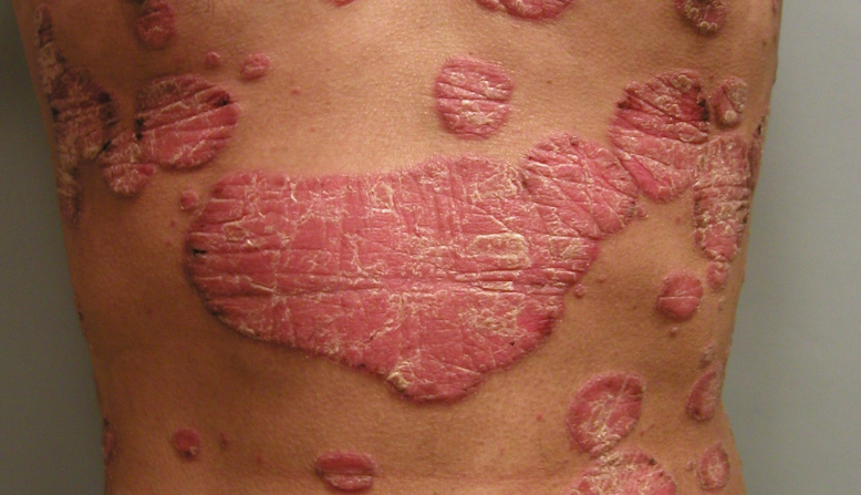 Plaque psoriasis