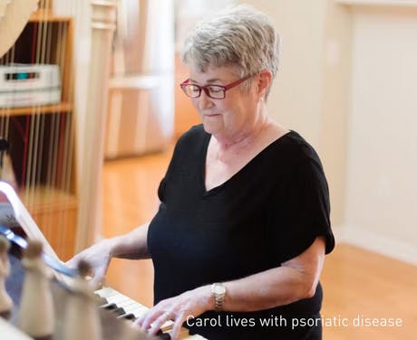 Woman playing a piano. Captioned "Carol lives with psoriatic disease"