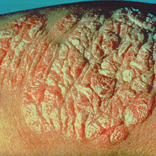 Psoriasis: Causes, Triggers And Treatments: National Psoriasis Foundation