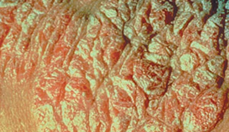 Plaque psoriasis close up image above link to plaque psoriasis page