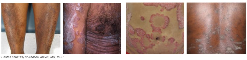 4 images of psoriasis on skin of color