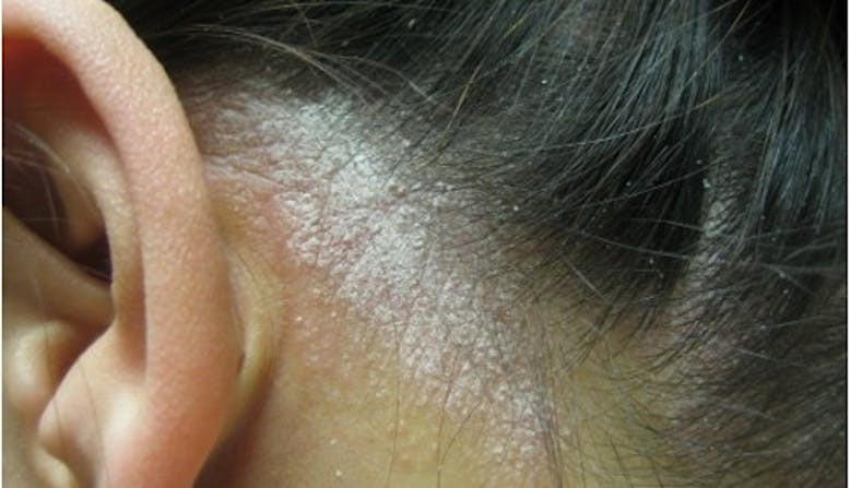 Scalp psoriasis behind a female's ear, along her hairline. 
