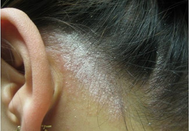 plaque psoriasis ear