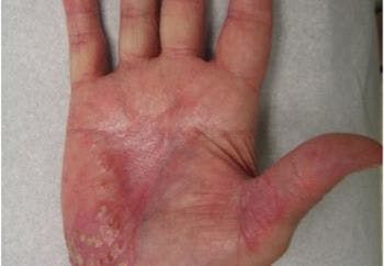 A hand impacted by pustular psoriasis