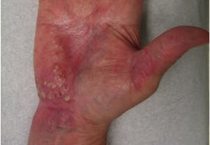 Pustular psoriasis on the hand, found on the Symptoms section of the page. 