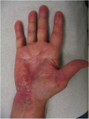 mild psoriasis on hands