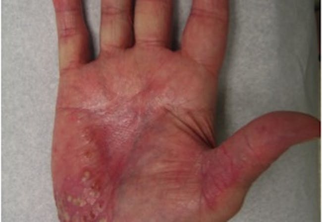 localized pustular psoriasis