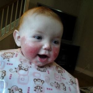 Leah Tarabocchia as an infant with psoriasis on her cheeks.