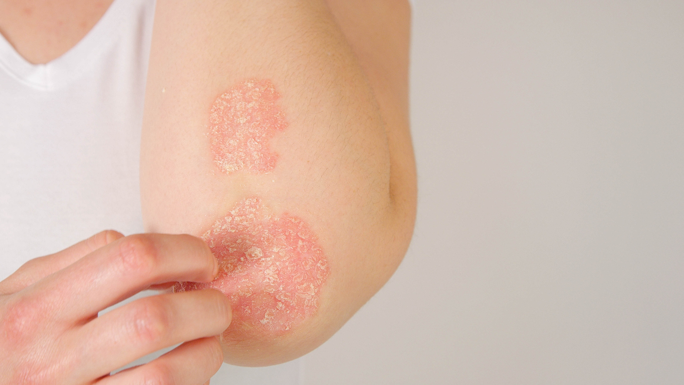 Stock image of psoriasis on an elbow