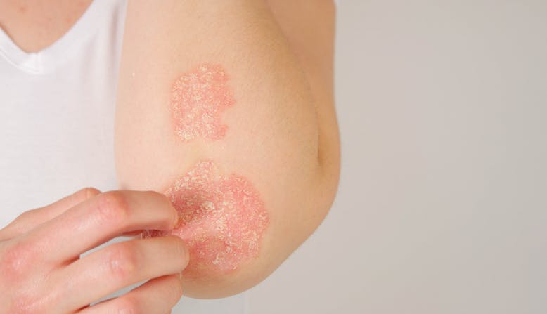 Stock image of psoriasis on an elbow