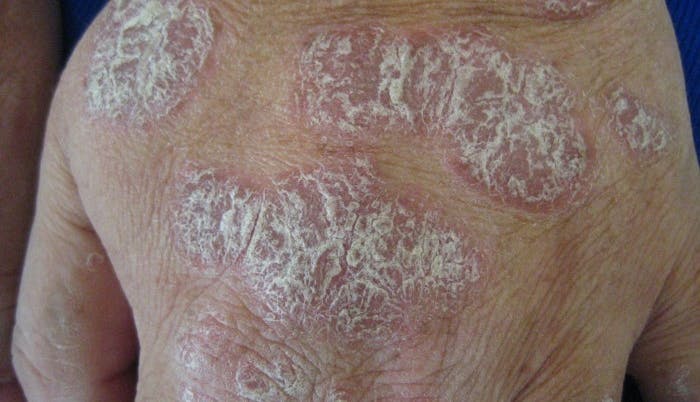 A man with plaque psoriasis on his back.