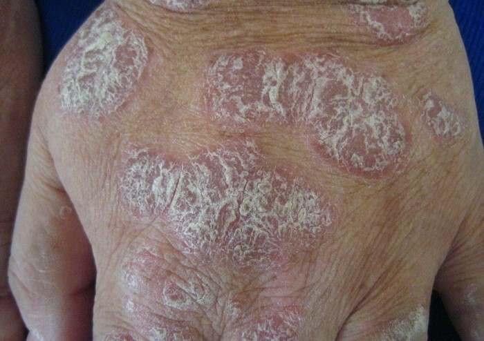 mild psoriasis