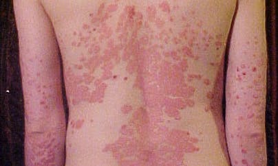 Image of Erythrodermic psoriasis on a person's back