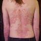 Image of Erythrodermic psoriasis on a person's back