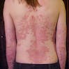 Image of Erythrodermic psoriasis on a person's back