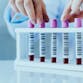 Hands of a lab technician with blood test sample tubes in a row for laboratory analysis.