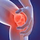 Illustrated knee pain to represent psoriatic arthritis. 