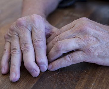The hands of a man with psoriatic arthritis on a wooden table, showing deformities in the fingers.