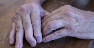 The hands of a man with psoriatic arthritis on a wooden table, showing deformities in the fingers.