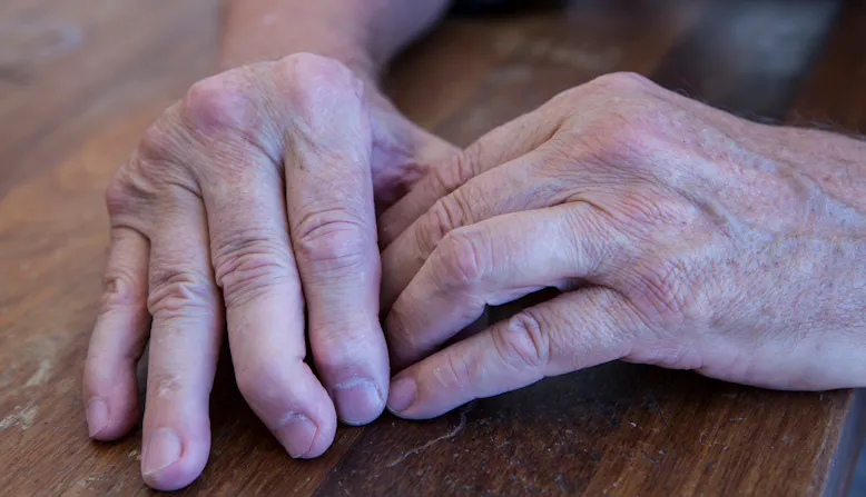 The hands of a man with arthritis on a wooden table, showing deformities in the fingers.