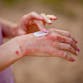 A woman puts lotion on her reddened skin.