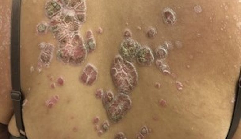 An image of a woman's back covered in psoriasis.