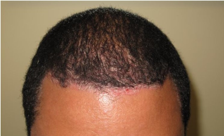 Does Scalp Psoriasis Cause Hair Loss  Cleveland Clinic