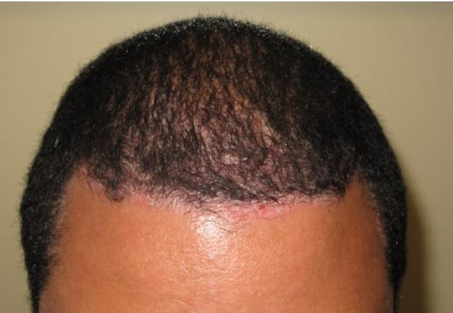 Scalp psoriasis image, skin of color, courtesy of Amit Garg, M.D.