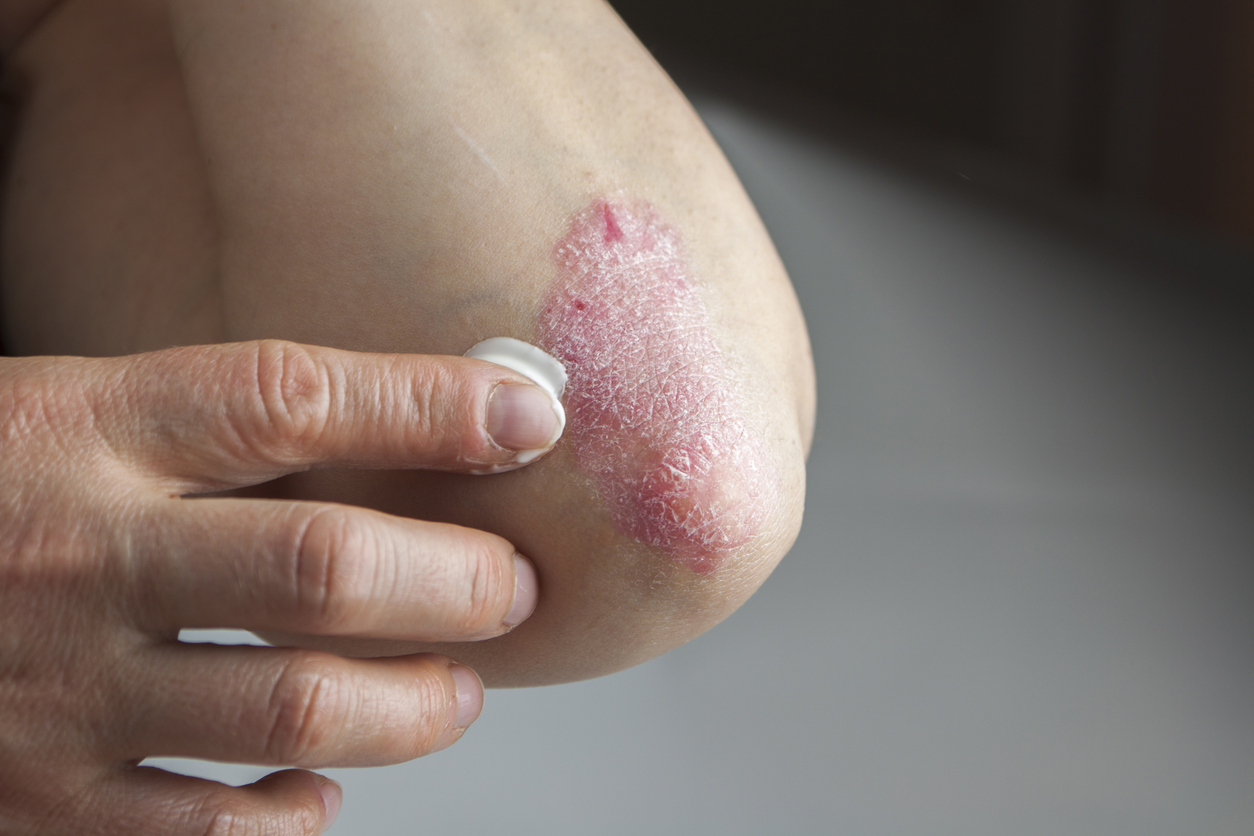A person applies cream to psoriasis on their elbow.