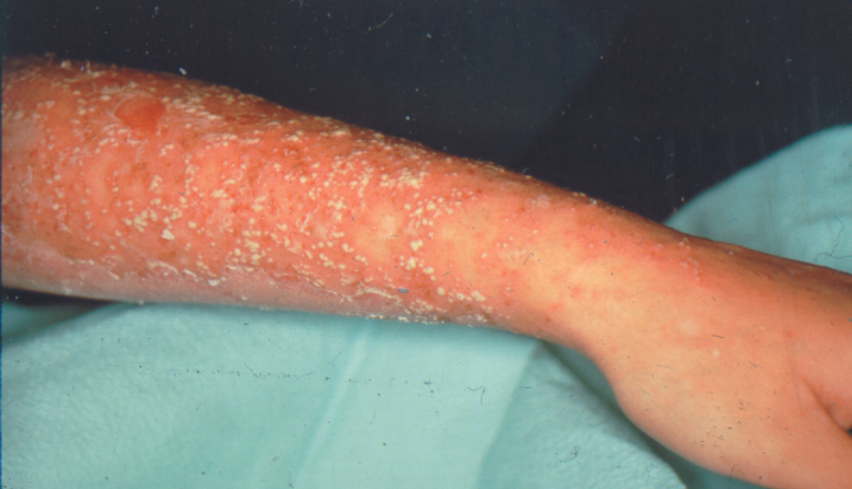 Pustular psoriasis on the arm of a white person.