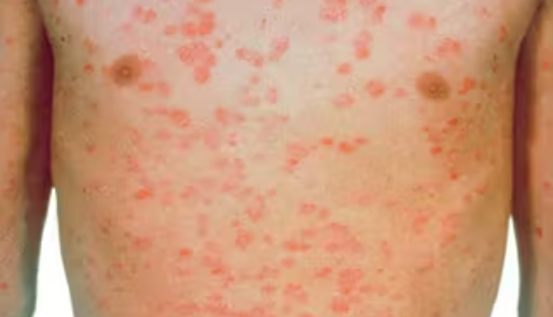 Guttate psoriasis on white skin.