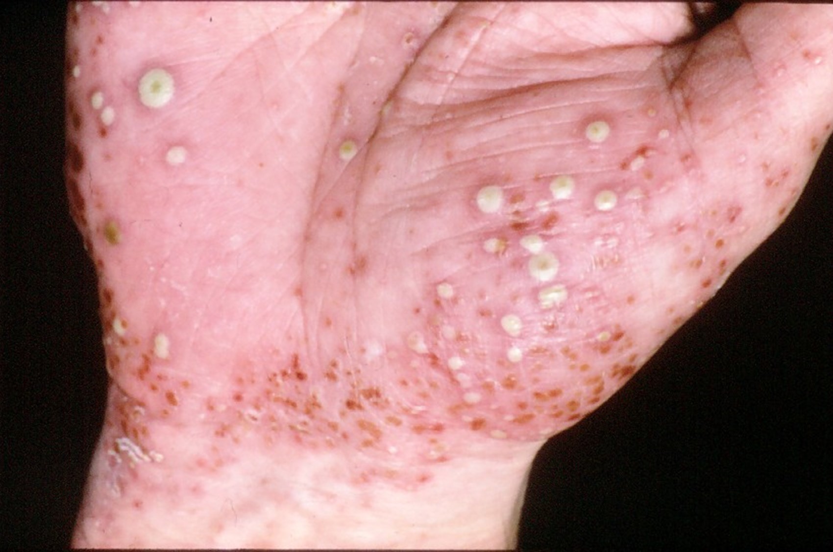 Pustular psoriasis on white skin.