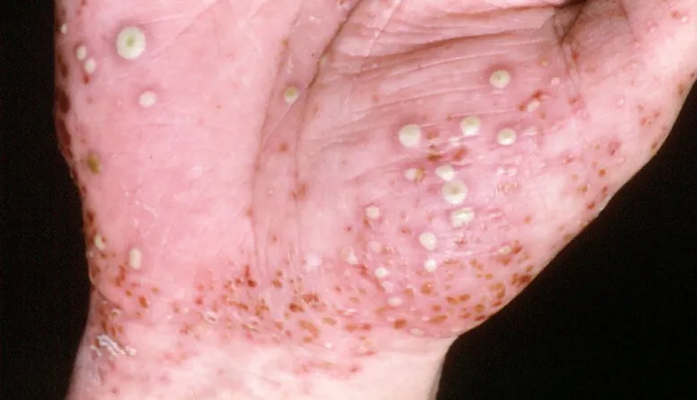 Pustular Psoriasis: Symptoms, Causes & Treatment