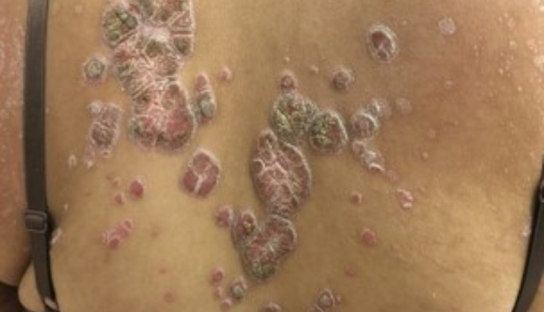Plaque psoriasis on skin of color
