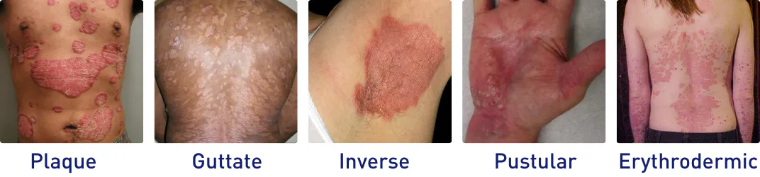 Plaque, Guttate, Inverse, Pustular, and Erythrodermic psoriasis