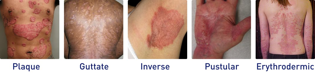 Plaque, Guttate, Inverse, Pustular, and Erythrodermic psoriasis